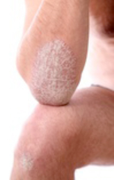 Psoriasis