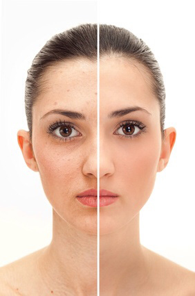 Rejuvenecimiento Facial