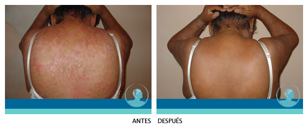 Testimonio Psoriasis