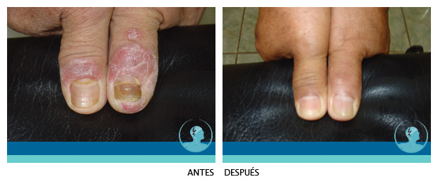 Testimonio Psoriasis