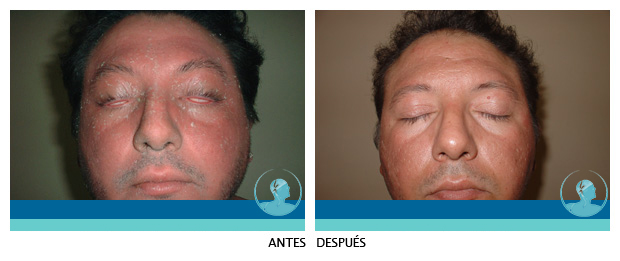Testimonio Psoriasis