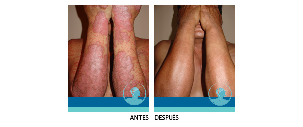 Testimonio Psoriasis